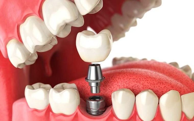 Implante dental con su corona