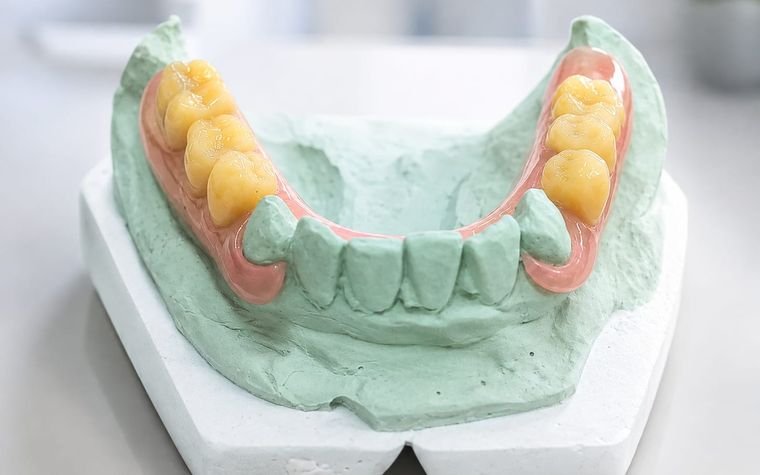 Profesional mostrando modelos de prótesis dental